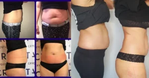 Explore The Cryoslimming Before And After